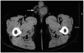 These other types are rarer. Malignant Mesothelioma Of The Tunica Vaginalis Testis A Case Report And Literature Review