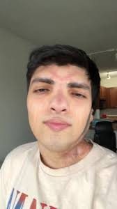 I had to, its low handing fruit #failedfirebender #zuko #burnsurvivor