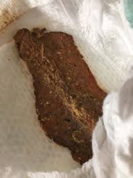 Image result for blood in stool human poop