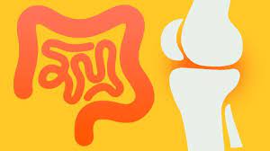 Crohn S Disease And Arthritis What S The Connection Crohn S Disease Center Everyday Health