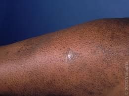 Image result for Keratosis pilaris