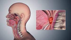 It can affect both adults and children. Throat Cancer Symptoms Pictures Causes And Treatment