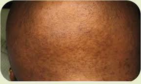 The shaving and hair removal market in the acne keloidalis nuchae is most commonly seen in african americans and is characterized by follicular papules and chronic plaques on the occipital. Before After Elite Laser Skin Care