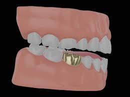 What's the best kind of crown for your tooth? What Is A Gold Tooth Crown And What Are The Benefits