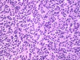 Webpathology Com A Collection Of Surgical Pathology Images
