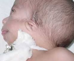 Überprüfen sie die übersetzungen von 'franceschetti syndrome' ins deutsch. Http Revgmespirituana Sld Cu Index Php Gme Article View 816 683