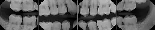 It is also difficult for the average patient to simply google the answer to this question as it is shrouded in convoluted dental terminology. Digital X Rays Blackhart Albertoni Corso Dentistry