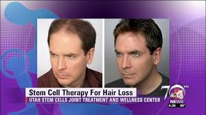 Hair loss news and hair loss prevention. Stem Cells Now Useful In Overcoming Hair Loss