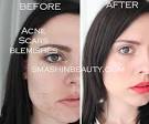 Best foundationcoverup for acne scars? - Weddingbee