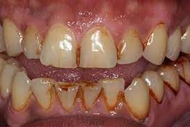 Pin On Teeth Whitening
