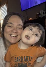 Understanding Campomelic Dysplasia through ASL Conversations