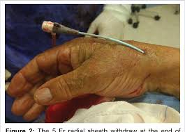 Pdf Distal Transradial Access In The Anatomical Snuffbox For Coronary Angiography And Aortography Semantic Scholar Snuff boxes and other accoutrements. pdf distal transradial access in the