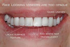 Bad Veneers Dental Veneers Veneers Teeth Veneers