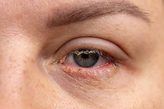 8 Causes of Crusty Eyes and How To Treat Them