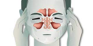 Anosmia es la pérdida total del olfato. Que Es La Rinosinusitis Portalclinic