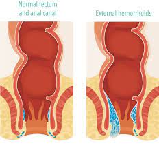 Hemorrhoids During Pregnancy Safe Tips Tricks And Treatments