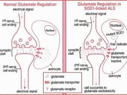 Pathophysiology of asthma consists of three key abnormalities: Amyotrophic Lateral Sclerosis Amyotrophic Lateral Sclerosis Nerve Cell Lou Gehrigs Disease
