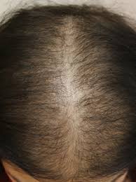 Systemic drugs—cytotoxic agents, anticoagulants, immunosuppressants, and some antithyroid drugs—may cause diffuse hair loss, usually an anagen effluvium as mentioned above. I Need Professional Hair Loss Advice On Diffuse Thinning