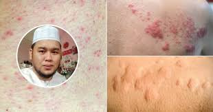 Pastu gatal hilang terus, bkn sementara mcm krim² yang kita selalu beli tu. Cara Merawat Kayap Kurap Panau Sakit Kulit Gatal Dengan Berkesan