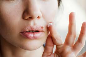 Herpes Simplex Cos E Come Si Trasmette E Come Si Cura