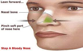 Emergency First Aid For Nurses A Practical Guide Medical Remedy Nose Bleeds Medical Help