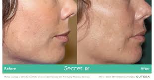 Cutera Enters Two New Aesthetic Markets With Launch Of New Products