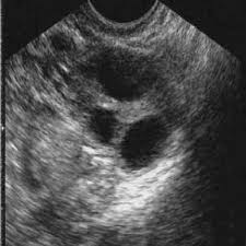 Langer, md • edward r. Follicle Detection And Ovarian Classification In Digital Ultrasound Images Of Ovaries Intechopen