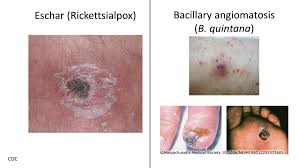 Image result for Rickettsialpox