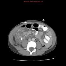 Image result for phlegmon on face)