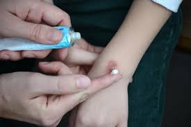 Apr 12, 2019 · 6 min read. Burn Scars Treatment Removal And Prevention
