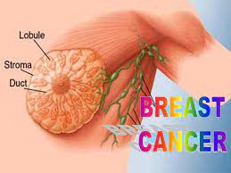 Learn the signs and symptoms of breast cancer and talk to your doctor immediately if you experience any of these signs. Breast Cancer Ppt Download