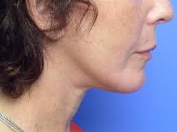 Facial implants: Chin Before & After Photos Patient 92