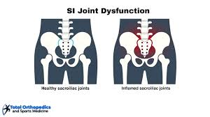 Image result for Sacroiliac Dysfunction