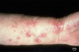 Image result for Pemphigoid