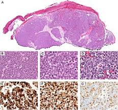 Merkel cell carcinoma demosgraphics, morphology, and survival based on 3870 cases: Merkel Cell Carcinoma Wikipedia