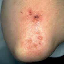 Dermatitis Herpetiformis Tidsskrift For Den Norske Legeforening