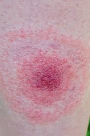 Lyme Disease Rash Symptoms Stages And Identification
