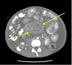 Celiac Disease Ct Scan Wikidoc