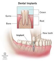 Image result for dental implant