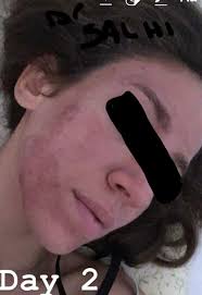 التقشير الكيميائي للوجه جميع المراحل Docteur Salhi Dermatologue Facebook