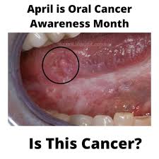 Image result for white cancer on tongue)