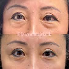 The goal of lower eyelid blepharoplasty is a smooth lid- cheek junction.  Pictured is my beautiful patient before & after scarless lower eyelid  blepharoplasty with marked improvement in the hill ⛰️ of