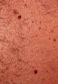 If you notice tiny, rough red spots on your skin—especially on your upper arms, thighs, cheeks, or buttocks—you may be dealing with keratosis pilaris, which are plugs of dead skin cells, according to. Cherry Angioma Cherry Hemangioma Senile Angioma Campbell De Morgan Spot Dermatology Advisor