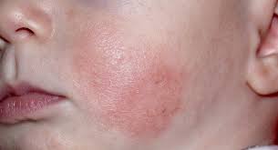 Seborrhoisches ekzem auf der kopfhaut und im gesicht. Dermatitis Bei Babys Ursachen Symptome Behandlung Und Medikamente Babycenter