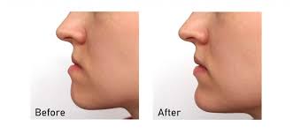 An orthodontist acquires complete records, including. Orthognathic Surgery Dr Arslan Reconstructive Aesthetic Surgery