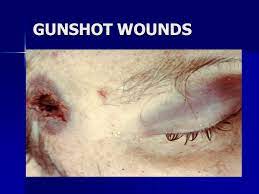 Jun 04, 2021 · a woman died of multiple gunshot wounds and a man died of one gunshot wound. Forensic Pathology Gunshot Wounds Ppt Video Online Download