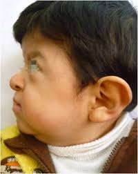 Expresividad variable en el síndrome de acrocefalosindactilia tipo I. A  propósito de dos pacientes