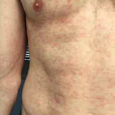 Maybe you would like to learn more about one of these? Core Concepts Syphilis Pathogen Based Diseases National Std Curriculum