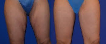 Thighplasty Is A Leg Lift Procedure Right For You Body Lift Surgery Thigh Liposuction Excess Skin