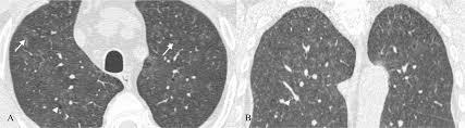 Image result for Ill-defined centrilobular nodular